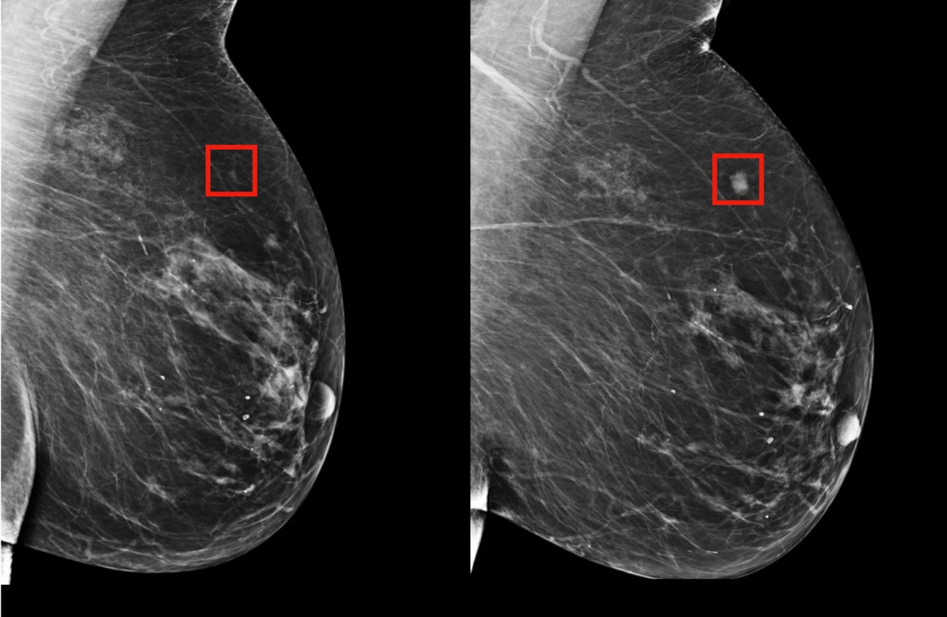 OncoPredict AI Breast Cancer Detection